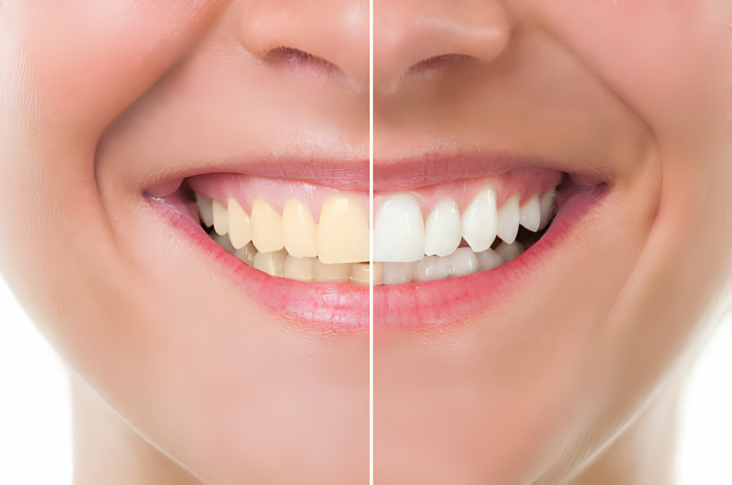 How to Maintain Your Bright Smile After Teeth Whitening_2