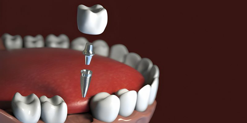 The Ultimate Guide: Post-Root Canal Dos and Don'ts_FI