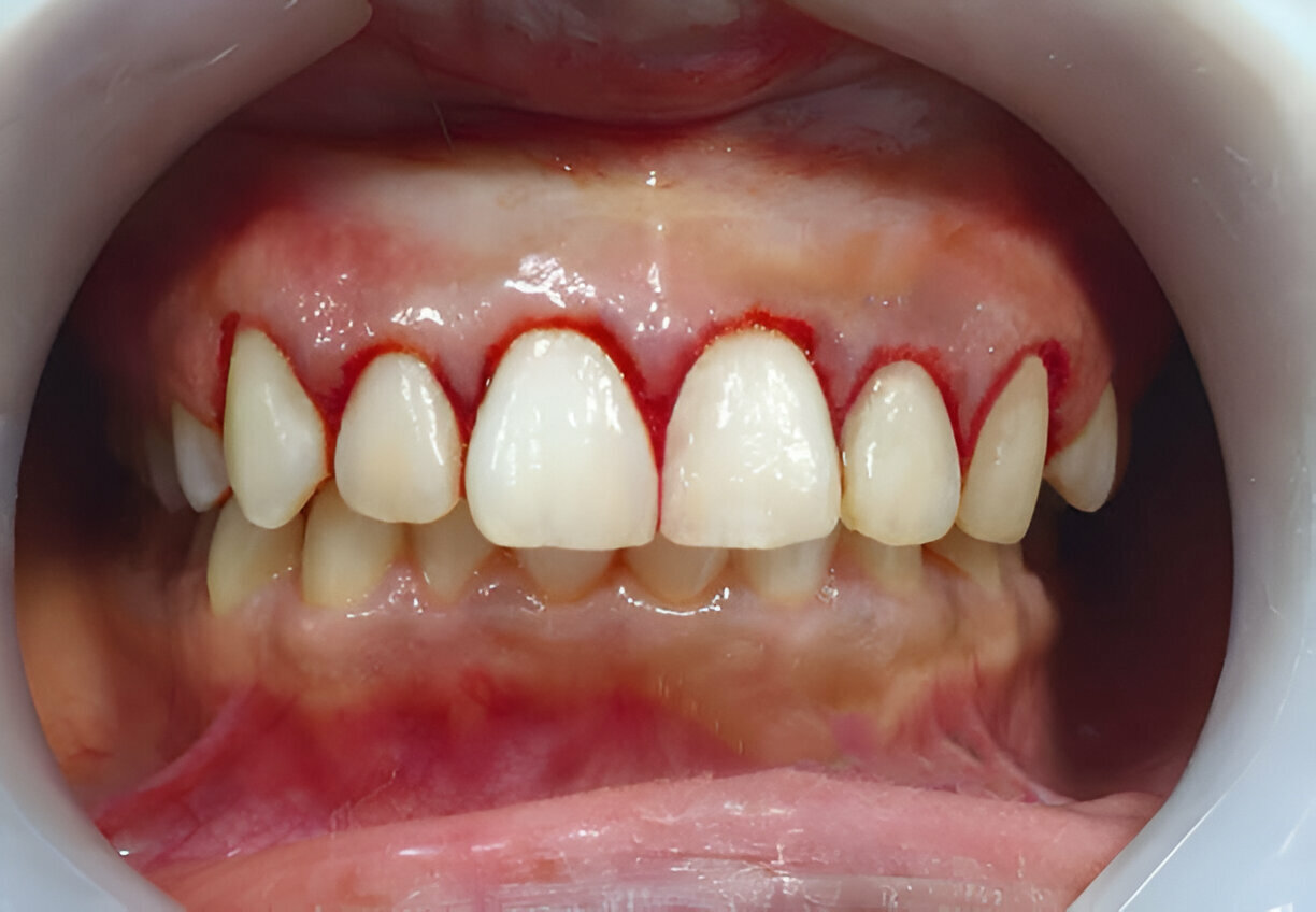 Advanced Gum Disease: Symptoms, Risks, and Treatment Options_3