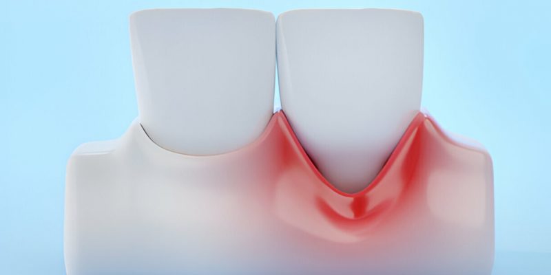 Advanced Gum Disease: Symptoms, Risks, and Treatment Options_FI