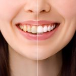 Discover the Secret to a Brighter Smile with Professional Teeth Whitening_FI