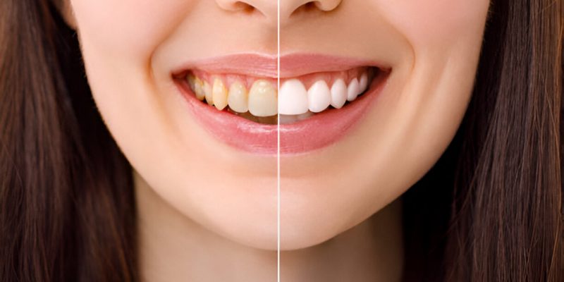 Discover the Secret to a Brighter Smile with Professional Teeth Whitening_FI