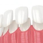 Transform Your Smile with Porcelain Veneers: A Complete Guide_FI