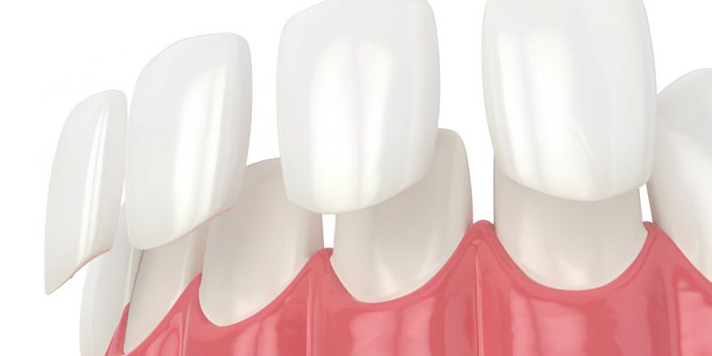 Transform Your Smile with Porcelain Veneers: A Complete Guide_FI