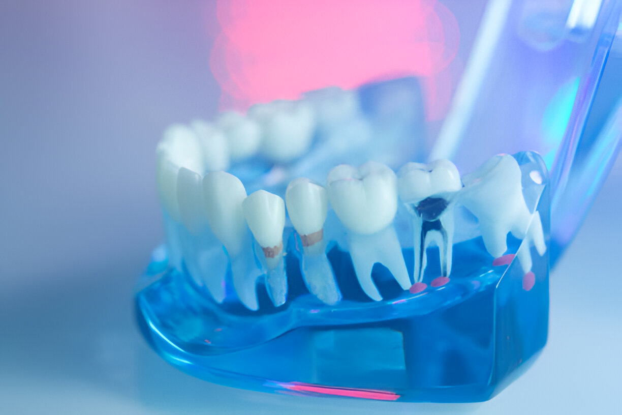 Just Got A Root Canal? Here’s How You Can Ensure Post-Procedure Care_1