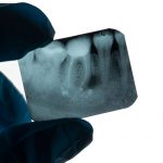 Just Got A Root Canal? Here’s How You Can Ensure Post-Procedure Care_FI