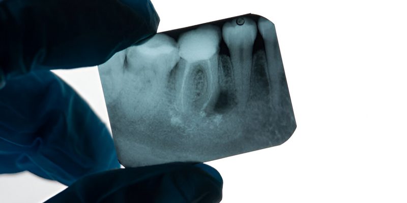 Just Got A Root Canal? Here’s How You Can Ensure Post-Procedure Care_FI