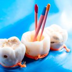 Top Dentist in Bloomfield for Root Canal Procedures: Why Sundance Bloomfield is the Go-To Choice_1