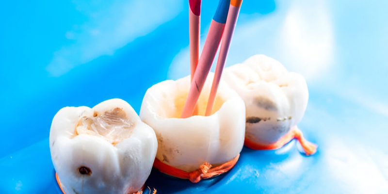 Top Dentist in Bloomfield for Root Canal Procedures: Why Sundance Bloomfield is the Go-To Choice_1