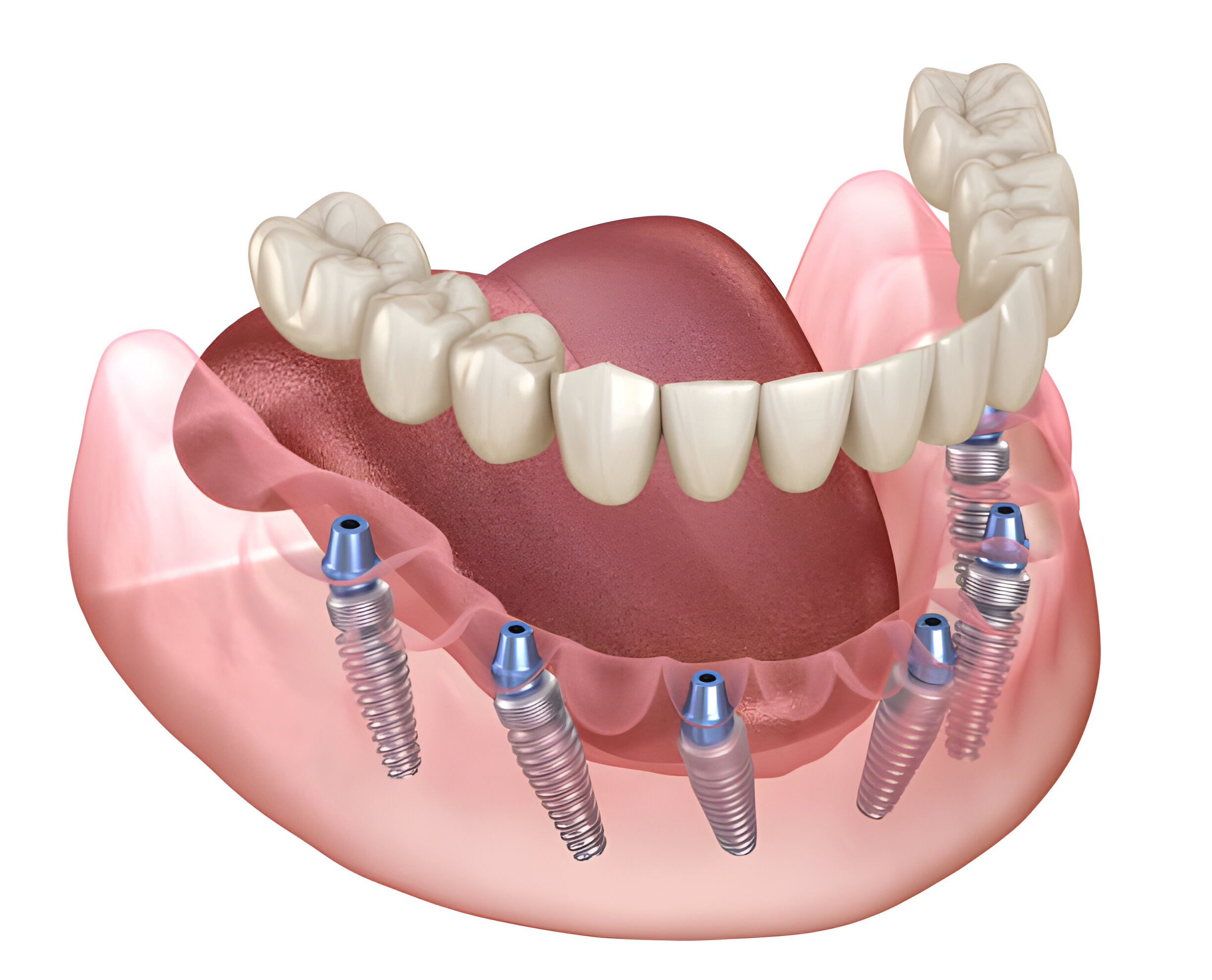 Dental Implants Aftercare: Tips for a Successful Recovery_1