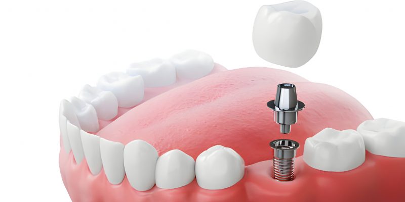 Dental Implants Aftercare: Tips for a Successful Recovery_FI