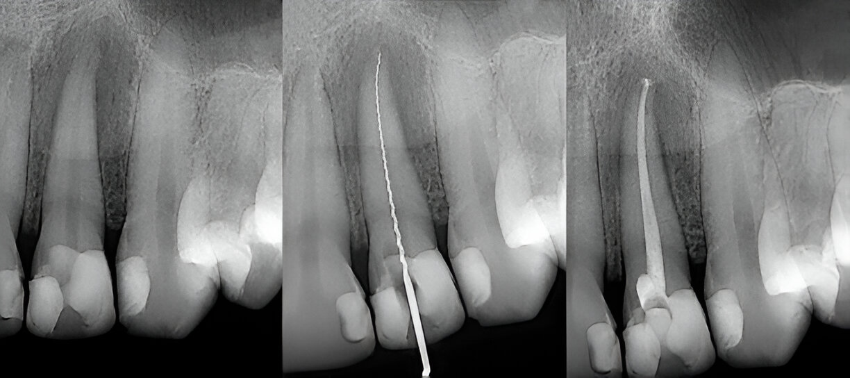 Top Dentist in Bloomfield for Root Canal Procedures: Why Sundance Bloomfield is the Go-To Choice_2