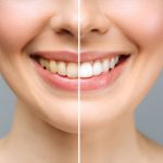 Professional Teeth Whitening in Grants: What to Expect at Sundance Dental_FI