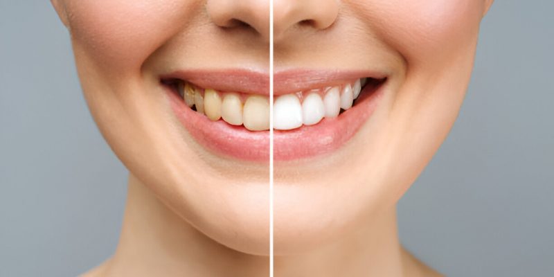 Professional Teeth Whitening in Grants: What to Expect at Sundance Dental_FI