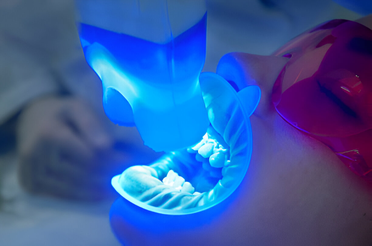 Teeth Whitening Dentists Near Me: Why Bloomfield Residents Trust Sundance Dental_2