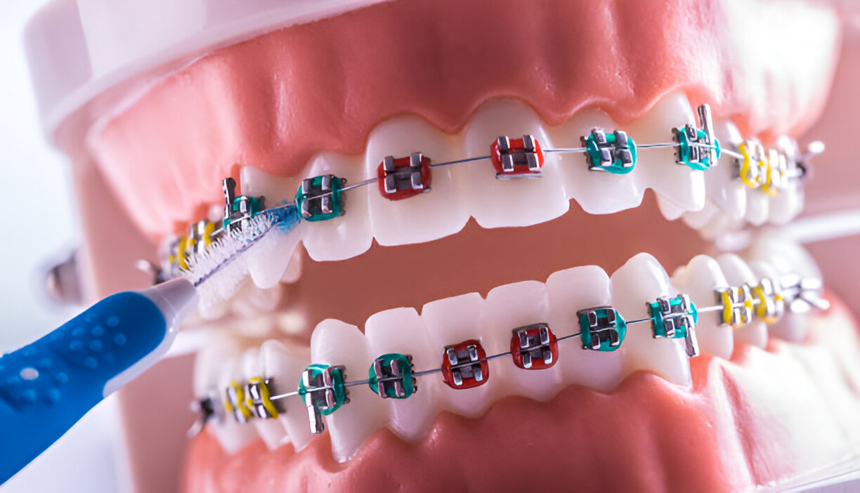 How a Dentist in Gallup, New Mexico Can Help Achieve a Perfect Smile with Orthodontics and Braces_2