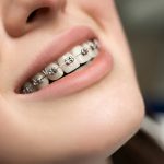 The Comprehensive Guide to Metal Braces at Sundance Dental Bloomfield: Advice from a Trusted Dentist in Bloomfield_FI