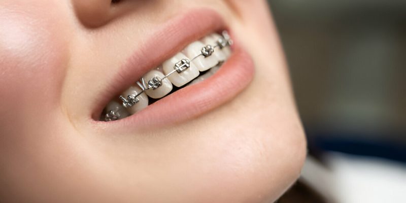 The Comprehensive Guide to Metal Braces at Sundance Dental Bloomfield: Advice from a Trusted Dentist in Bloomfield_FI