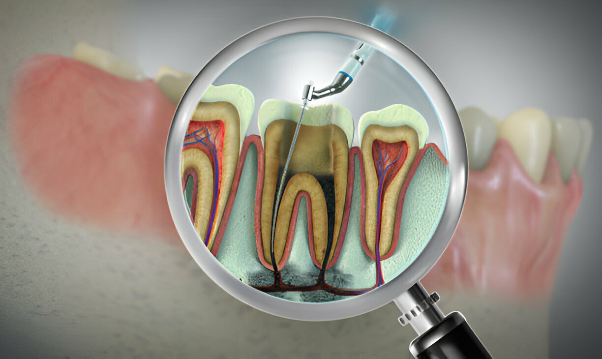 How Sundance Dental Grants Make Root Canals Stress-Free at Leading Dental Clinics in Grants_1