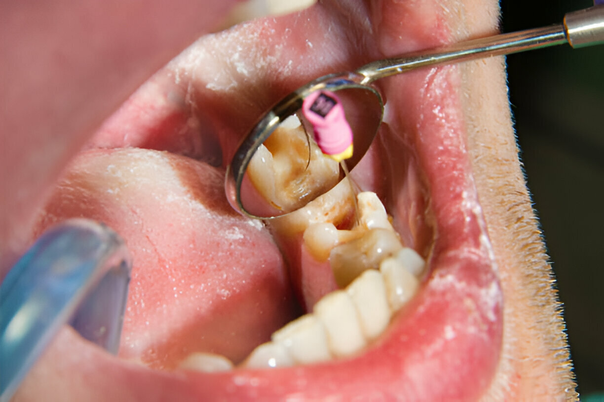 How Sundance Dental Grants Make Root Canals Stress-Free at Leading Dental Clinics in Grants_2