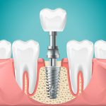 Everything You Need to Know About Dental Implants: Expert Advice from Sundance Dental in Gallup, NM_FI