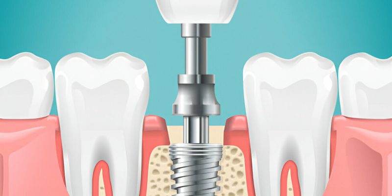 Everything You Need to Know About Dental Implants: Expert Advice from Sundance Dental in Gallup, NM_FI